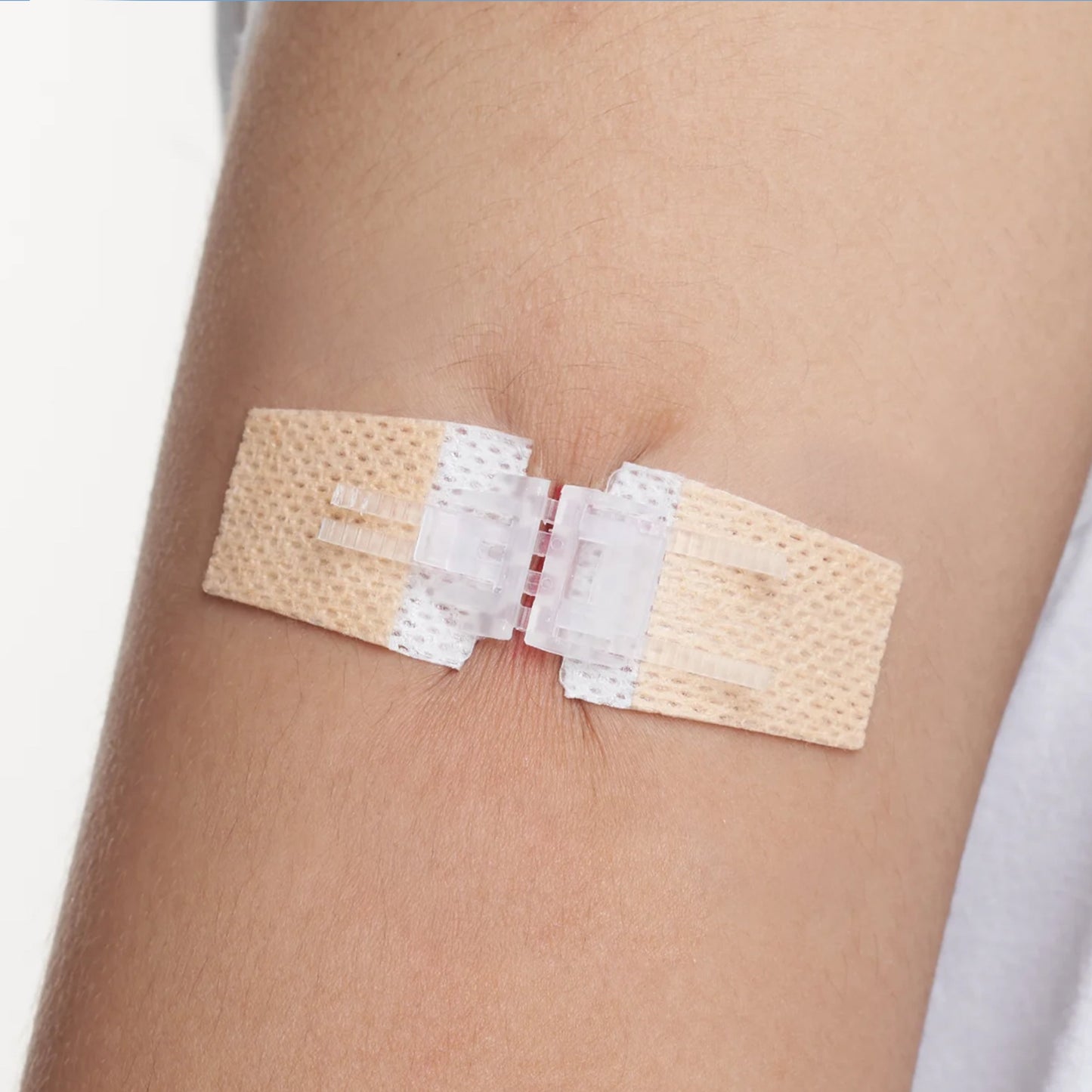 Advanced Wound Closure Kit: ZipClose Laceration (Stitch Free)