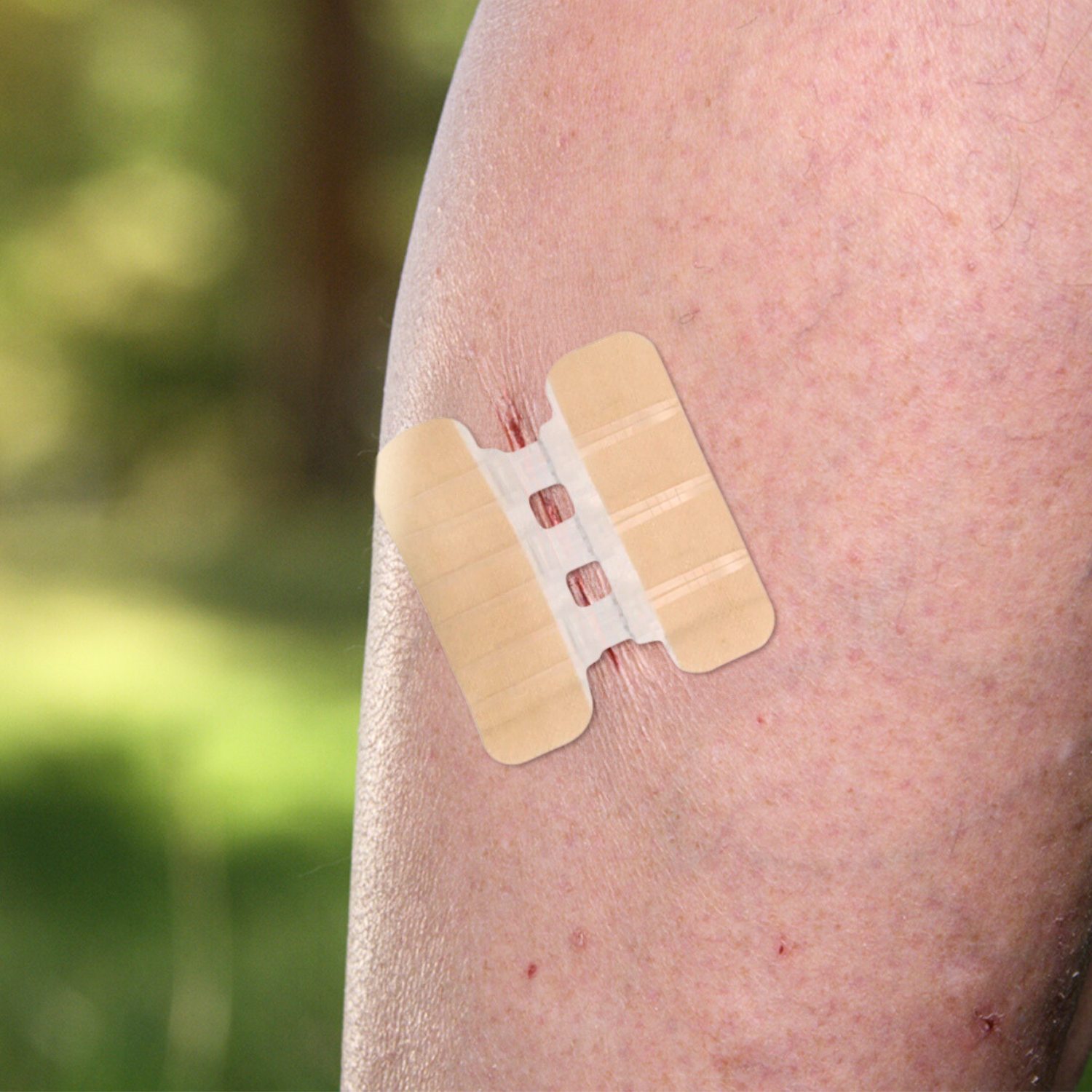 Advanced Wound Closure Kit: ZipClose Laceration (Stitch Free)